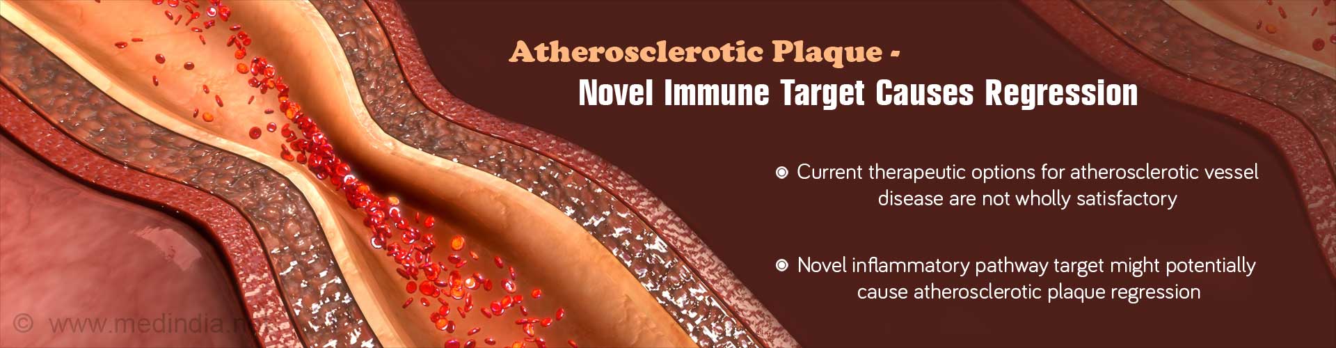 Atherosclerotic Plaque - Novel Immune Target Causes Regression
- Current therapeutic options for atherosclerotic vessel diseases are not wholly satisfactory
- Novel inflammatory pathway target might potentially cause atherosclerotic plaque regression