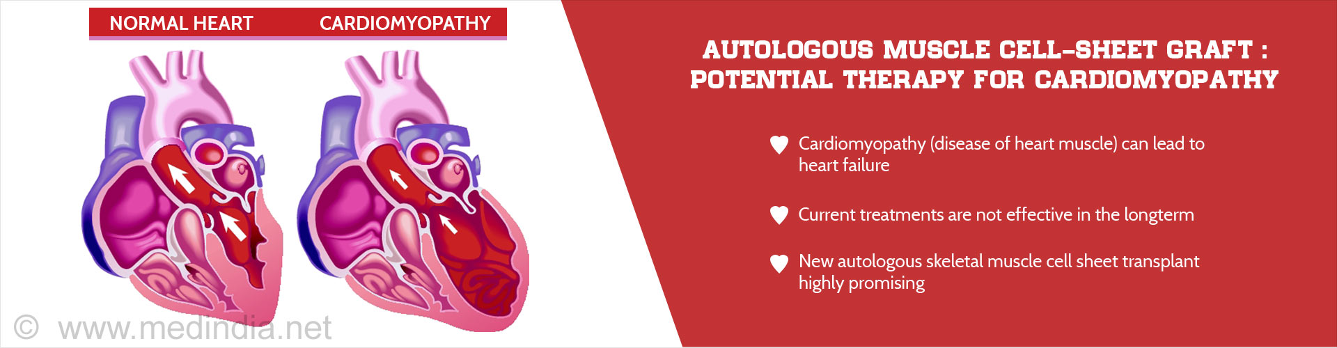 Autologous muscle cell-sheet graft: potential therapy for cardiomyopathy
- Cardiomyopathy (disease of heart muscle) can lead to heart failure
- Current treatments are no effective in the longterm
- New autologoues skeletal muscle cell sheeet transplant highly promising