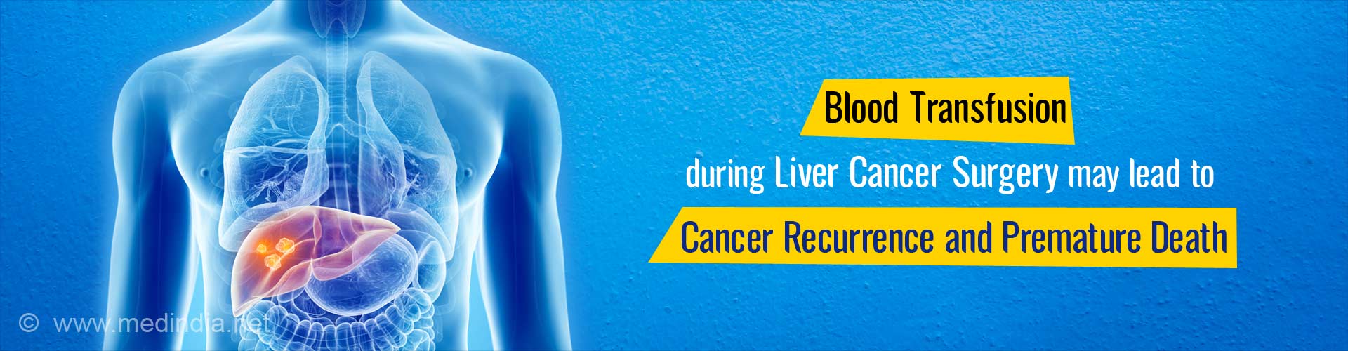 Blood Transfusion during Liver Cancer Surgery may Lead to Recurrence of Cancer and Death