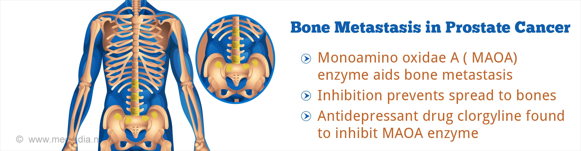 Bone metastasis in prostate cancer
- Monoamino oxidate A (MAOA) enzyme aids bone metastasis
- Inhibition prevents spread to bones
- Antidepressant drug clorgyline found to inhibit MAOA enzyme