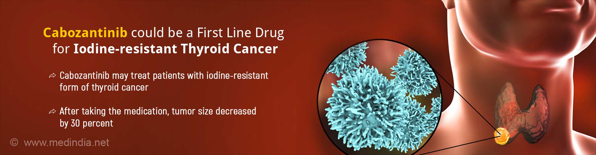 cabozantinib could be a first line drug for iodine-resistant thyroid cancer
- cabozantinib may treat patients with iodine-resistant form of thyroid cancer
- after taking the medication, tumor size decreased by 30 percent