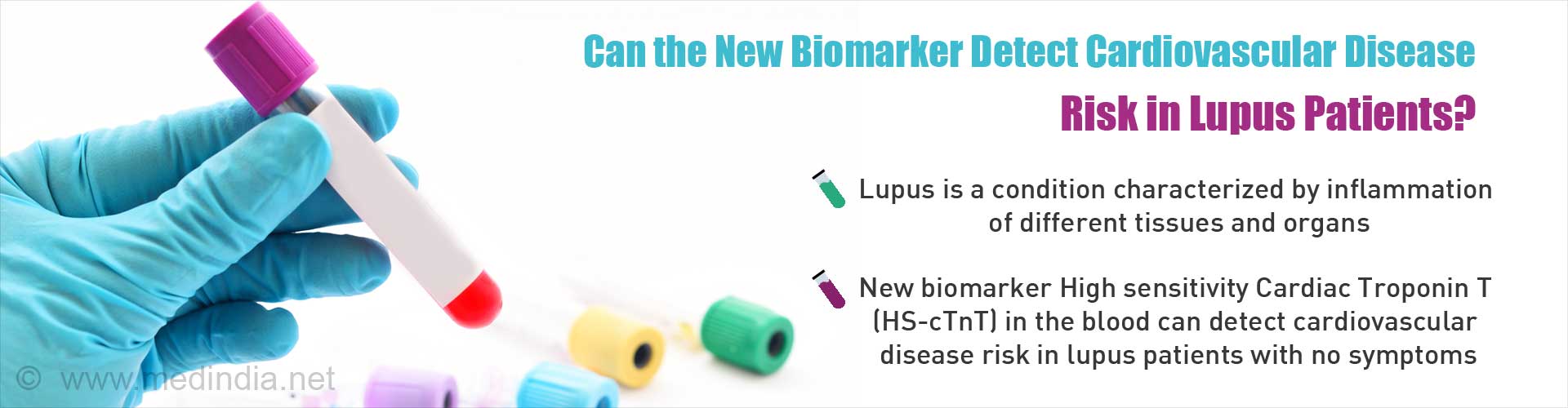 Can the new biomarker detect cardiovascular disease risk in lupus patients?
- Lupus is a condition characterized by inflammation in different tissues and organs
- New biomarker high sensitivity cardiac roponin T (HS-cTnT) in the blood can detect cardiovascular disease risk in lupus patients with no symptoms