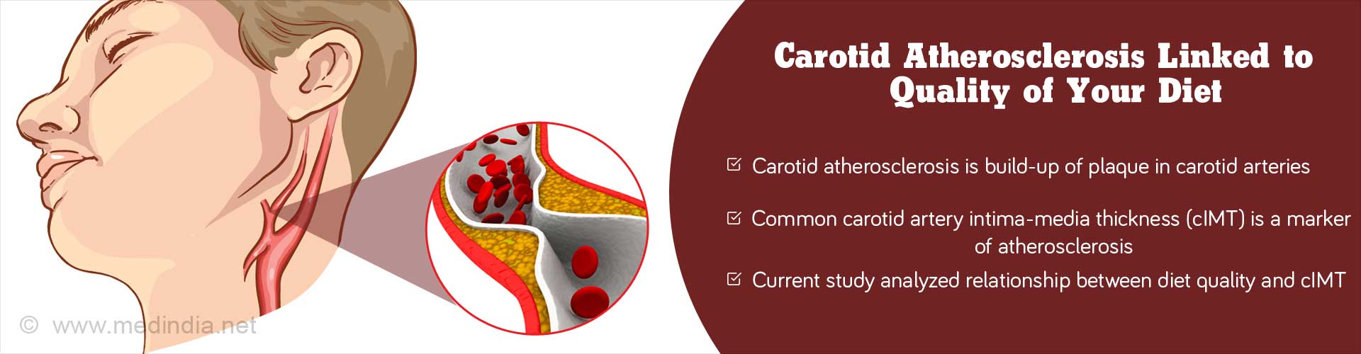 Carotid atherosclerosis linked to quality of your diet
- Carotid atherosclerosis is build-up of plaque on carotid arteries
- Common carotid artery intima-media thickness (cIMT) is a marker of atherosclerosis
- Current study analyzed relationship between diet quality and cIMT