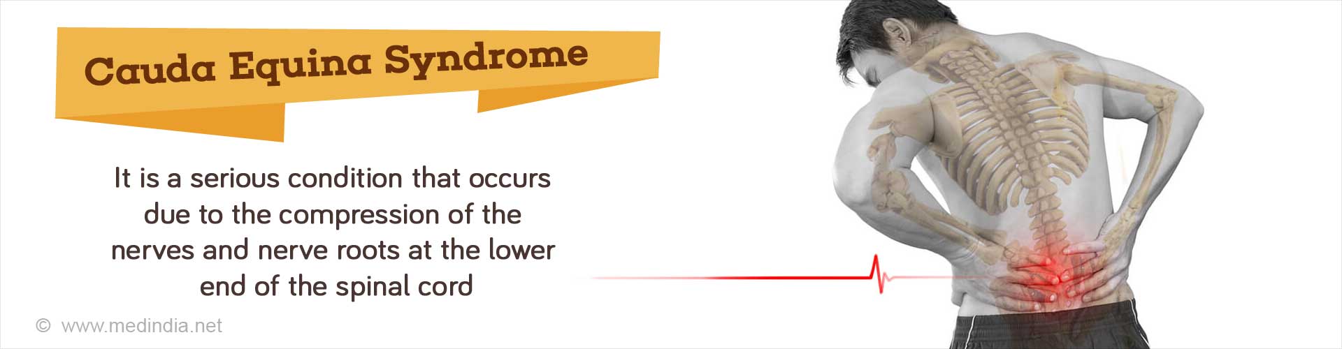 Cauda Equina Syndrome - It is a serious condition that occurs due to the compression of the nerves and nerve roots at the lower end of the spinal cord