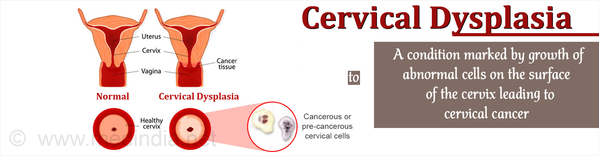 Cervical Dysplasia - A condition marked by growth of abnormal cells on the surface of the cervix leads to cervical cancer

Uterus
Cervix
Vagina
Cancer tissue

Normal/Cervical Dysplasia

Healthy cervix

Cancerous or pre-cancerous cervical cells