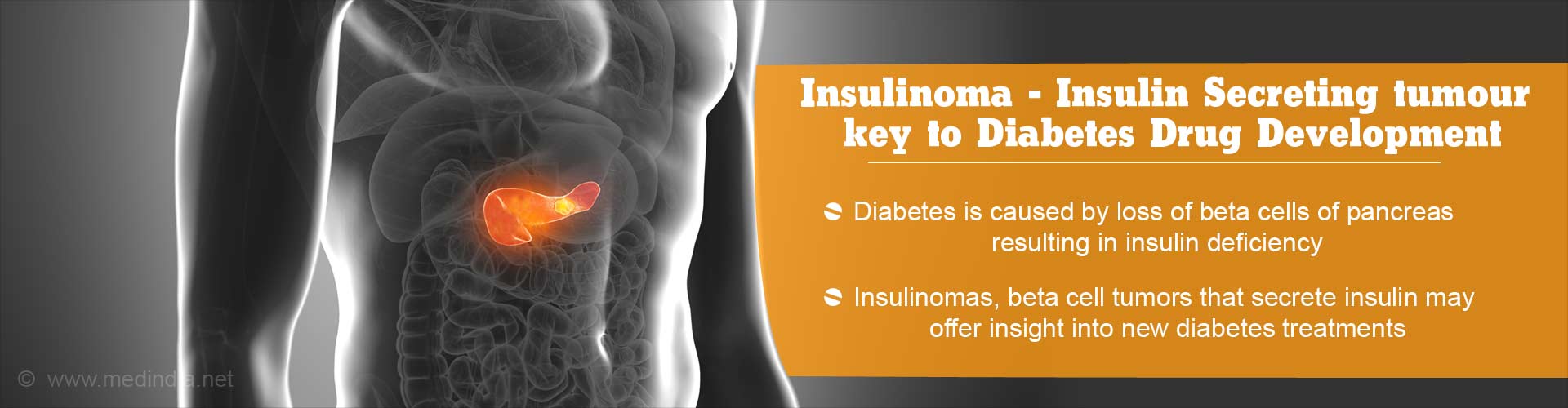 Insulinoma - Insulin secreting tumour key to diabetes drug development
- Diabetes is caused by loss of beta cells of pancreas resulting in insulin deficiency
- Insulinomas, beta cell tumors that secrete insulin may offer insight into new diabetes treatments