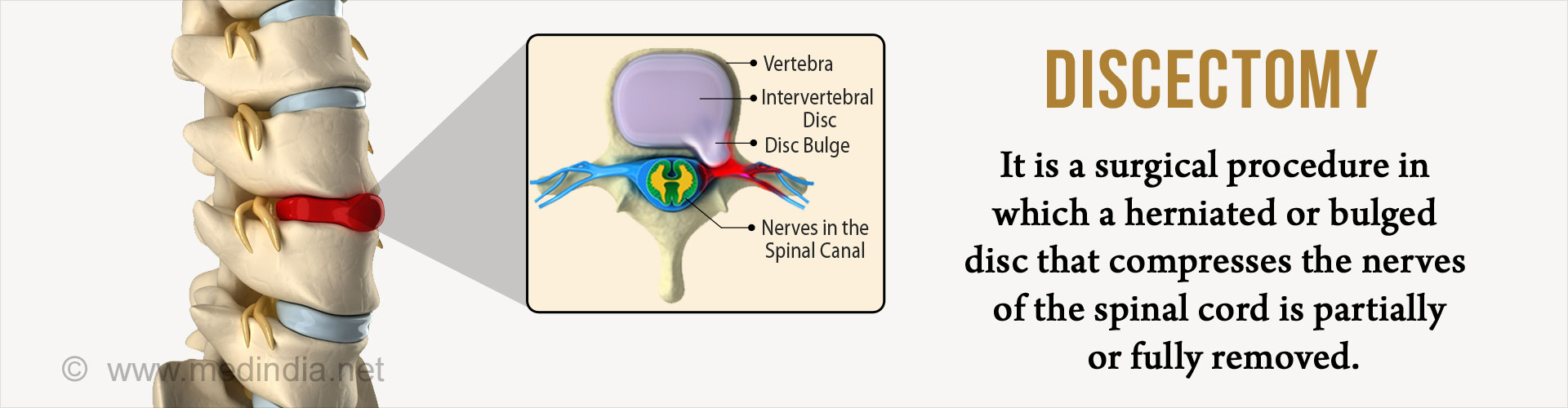 Discectomy - is a surgical procedure in which a herniated or bulged disc that compresses the nerves of the spinal cord is partially or fully removed.