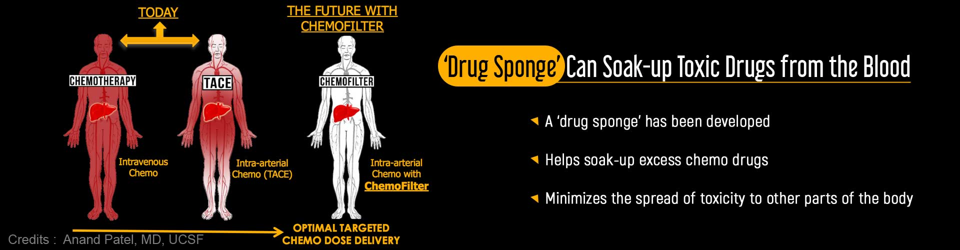 'Drug sponge' can soak-up toxic drugs from the blood. A 'drug sponge' has been developed. Helps soak-up excess chemo drugs. Minimizes the spread of toxicity to other parts of the body.