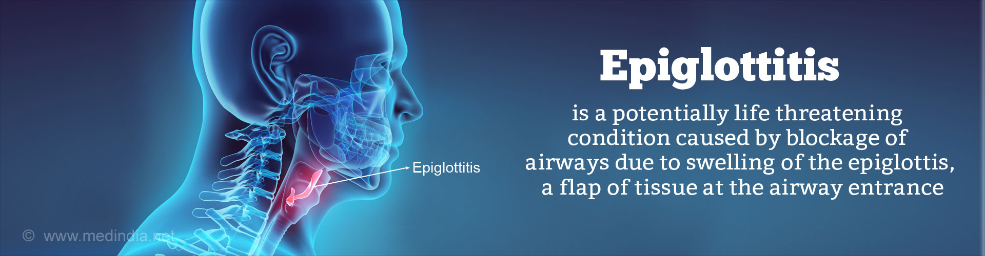 Epiglottitis is a potentially life threatening condition caused by blockage of airways due to swelling of the epiglottis, a flap of tissue at the airway entrance