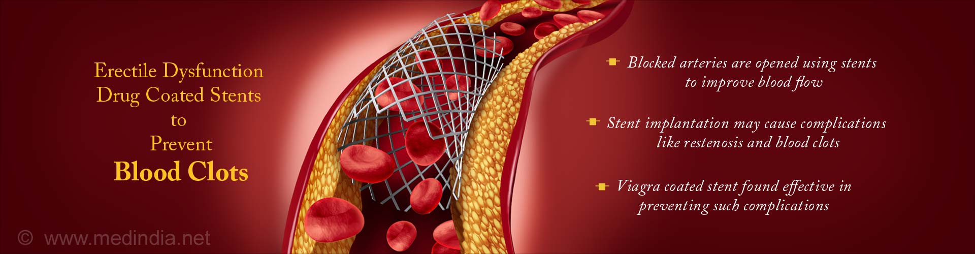 Erectile Dysfunction Drug Coated Stents to Prevent Blood Clots
- Blocked arteries are opened using stents to improve blood flow
- Stent implantation may cause complications like restenosis and blood clots
- Viagara coated stent found effective in preventing such complications