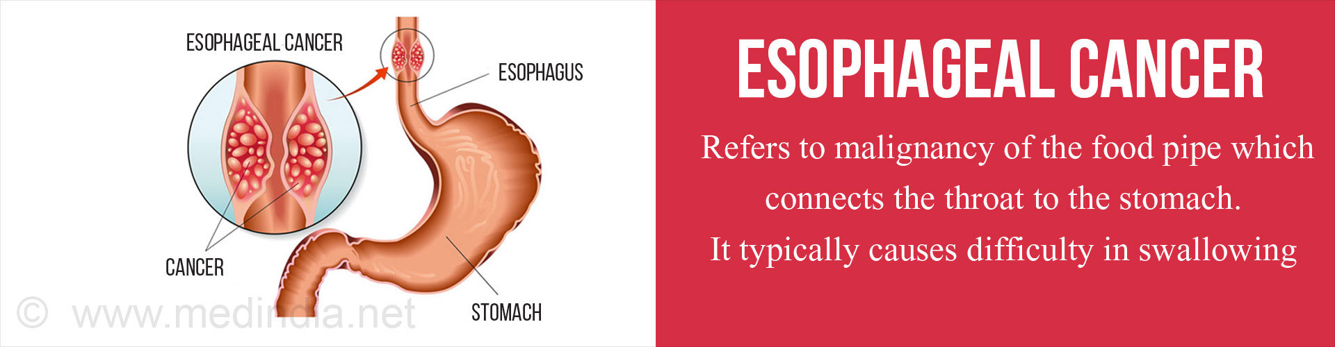 Esophageal cancer refers to malignancy of the food pipe which connects the throat to the stomach. It typically causes difficulty in swallowing