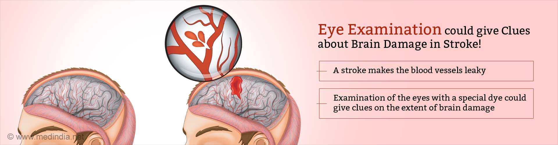 eye examination could give clues about brain damage in stroke
- a stroke make the blood vessels leaky
- examination of the eyes with a special dye could give clues on the extent of brain damage
