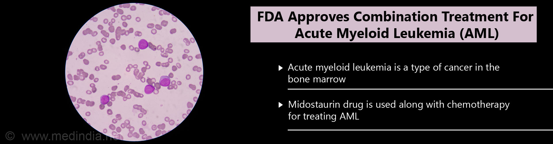 FDA approves combination treatment for acute myeloid leukemia (AML)
- Acute myeloid leukemia (AML) is a tyoe of cancer in the bone marrow
- Midostaurin drug is used along with chemotherapy for treating AML

