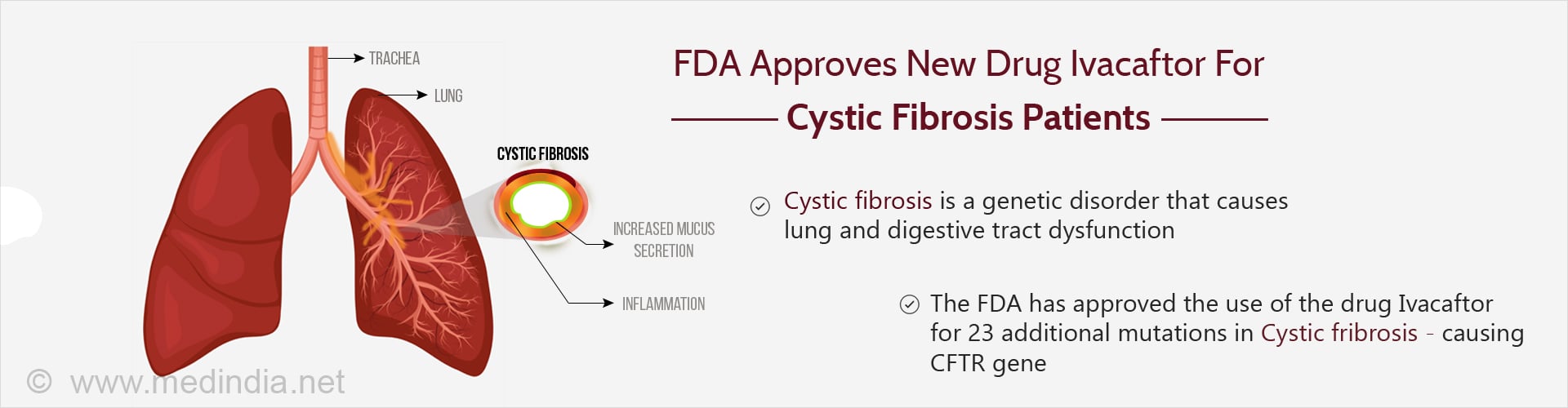 FDA approves new drug Ivacaftor for cystic fibrosis patients
- Cystic fibrosis is a genetic disorder that causes lung and digestive tract dysfunction
- The FDA has approved the use of the drug Ivacaftor for 23 additional mutations Cystic fibrosis - causing gene