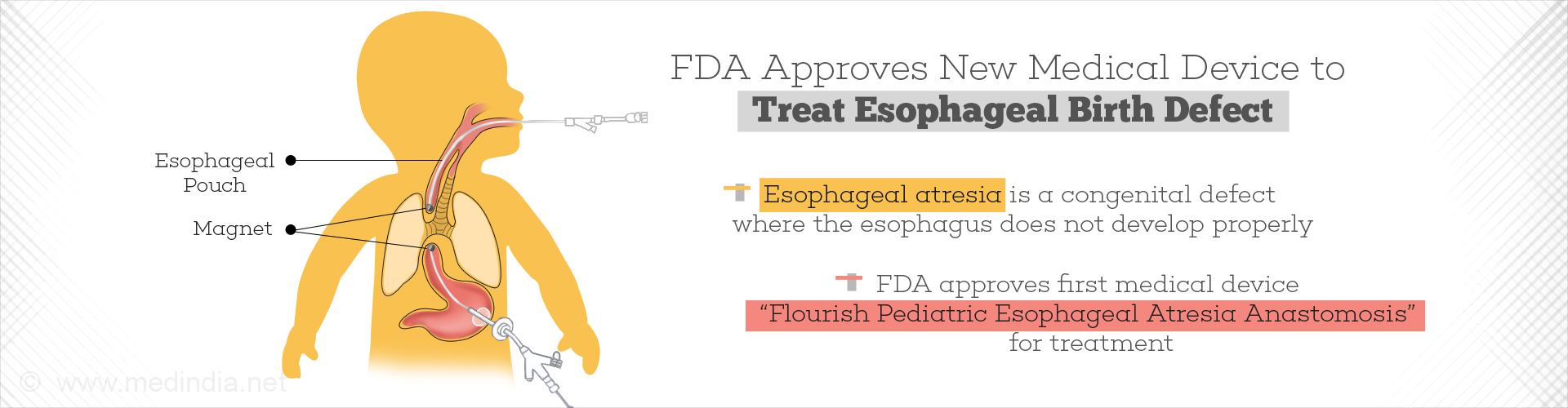 FDA approves new medical device to treat esophageal birth defect
- Esophageal atresia is a congenital defect where the esophagus does not develop properly
- FDA approves first medical device 