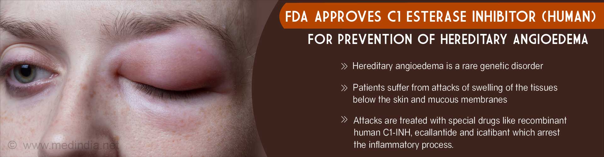 FDA Approves C1 Esterase Inhibitor (Human) for Prevention of Hereditary Angioedema
- Hereditary angioedema is a rare genetic disorder
- Patients suffer from attacks of swelling of the tissues below the skin and mucous membranes
- Attacks are treated with special drugs like recombinant human C1-INH, ecallantide and icatibant which arrest the inflammatory process
