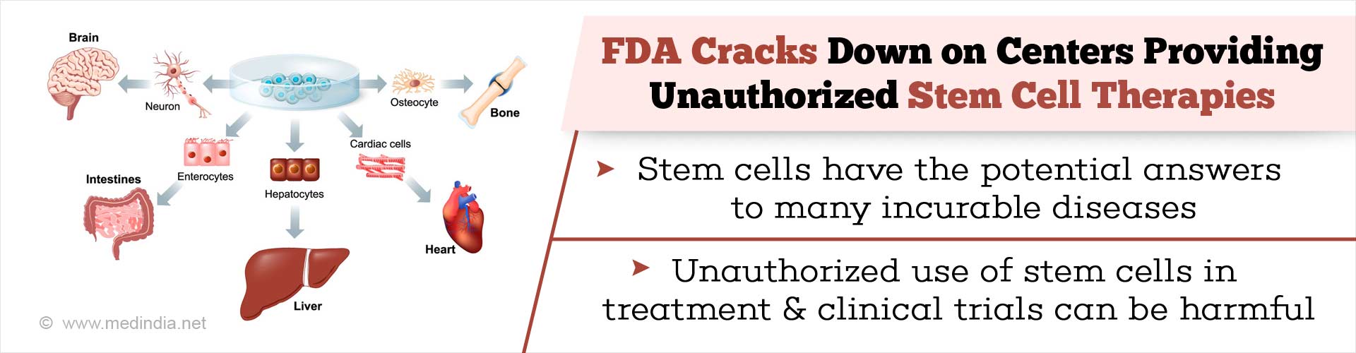 Effects of Unauthorized Stem Cell Therapies