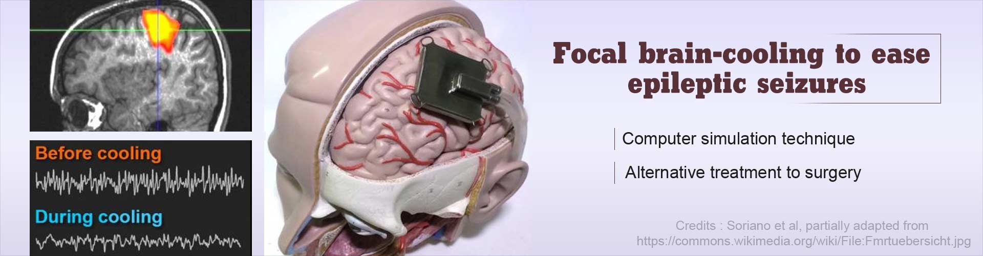 Focal brain-cooling to ease epileptic seizures
- Computer simulation technique
- Alternative treatment to surgery