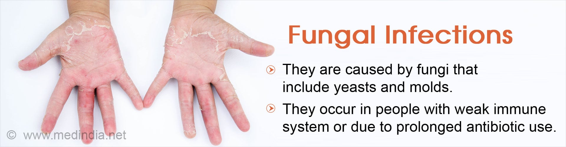 Fungal Infections
- They are caused by fungi that include yeasts and molds
- They occur in people with weak immune system or due to prolonged antibiotic use