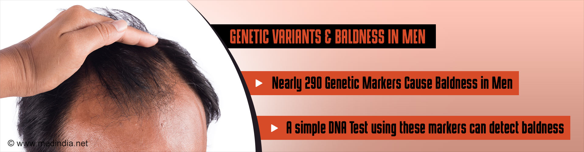 Genetic variants & baldness in men
- Nearly 290 genetic markers cause baldness in men
- A simple DNA ysing these markers can detect baldness