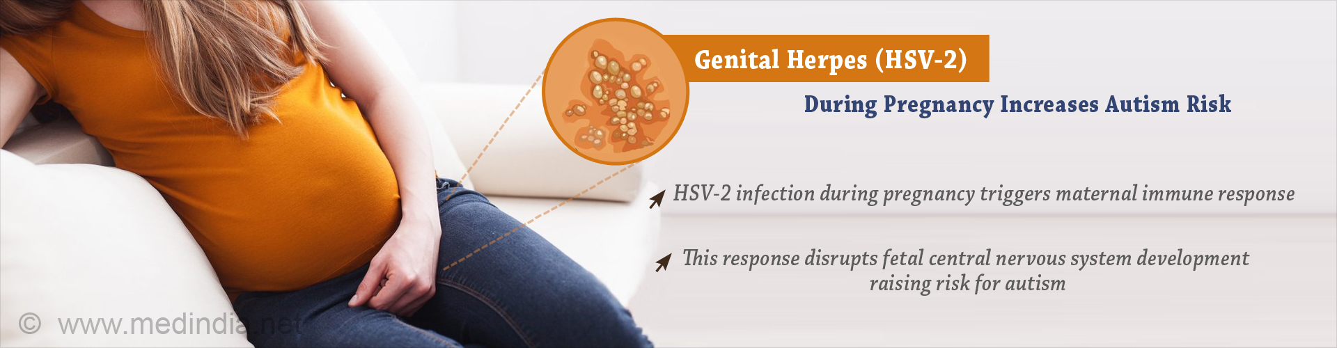 Genital Herpes (HSV-2) During Pregnancy Increases Autism Risk
- HSV-2 infection during pregnancy triggers material immune response
- This response disrupts fetal central nervous system development raising risk for autism