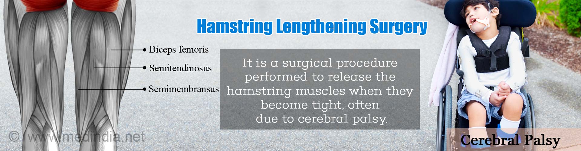 Hamstring Lengthening Surgery - It is a surgical procedure performed to release the hamstring muscles when they become tight, often due to cerebral palsy.