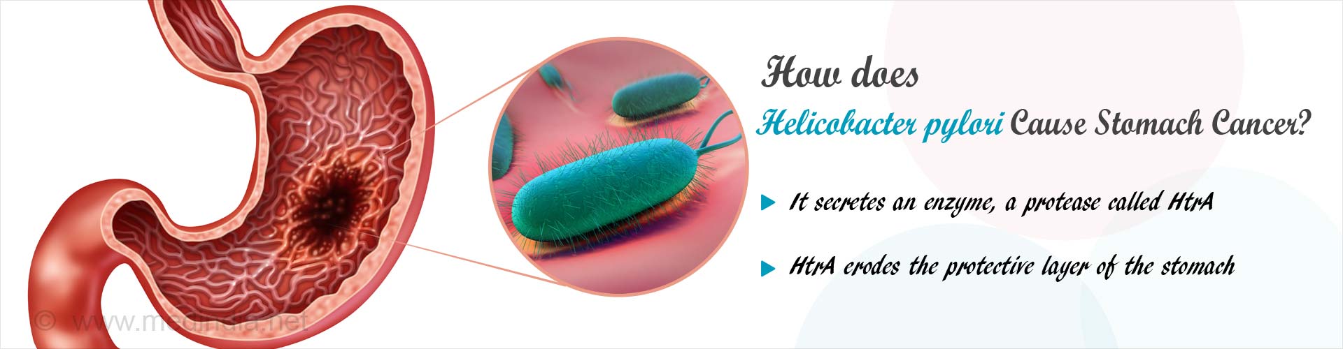 How does helicobacter pylori cause stomach cancer?
- it secretes an enzyme, a protease called HtrA
- HtrA erodes the protective layer of the stomach