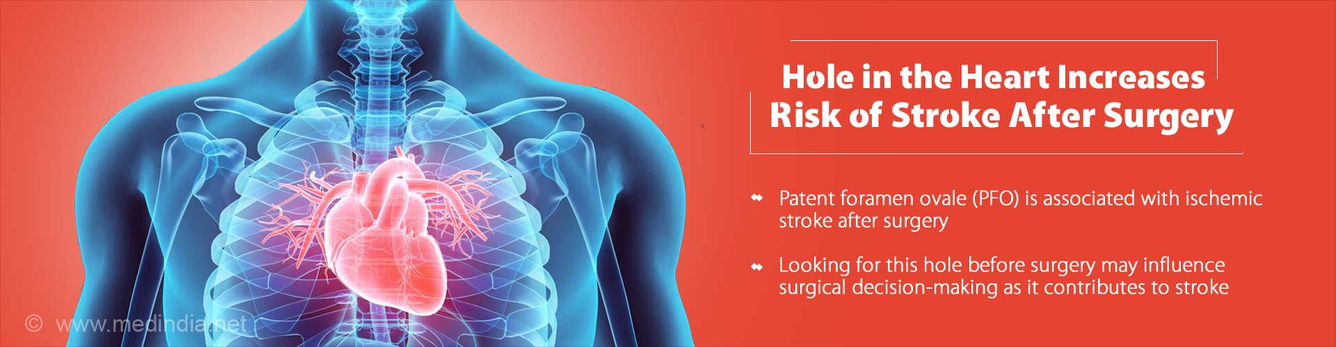 hole in the heart increases risk of stroke after surgery
- patent foramen ovale (PFO) is associated with ischemic stroke after surgery
- looking for this hole before surgery may influence surgical decision-making as it contributes to stroke