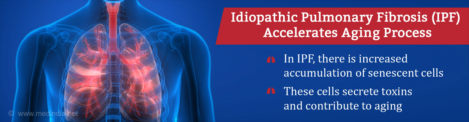 Idiopathic pulmonary fibrosis (IPF) accelerates aging process
- In IPF, there is increased accumulation of senescent cells
- These cells screte toxins and contribute to aging