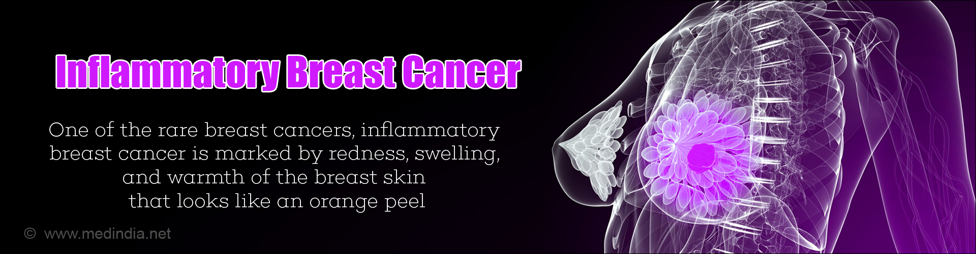 Inflammatory Breast Cancer
- One of the rare breast cancers, inflammatory breast cancer is marked by redness, swelling, and warmth of the breast skin that looks like an orange peel