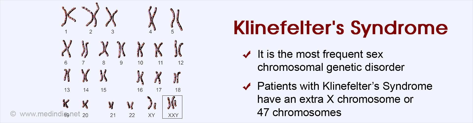 Klinefelter's Syndrome
- It is the most frequent sex chromosomal genetic disorder
- Patients with Klinefelter's Syndrome have an extra X chromosome or 47 chromosomes