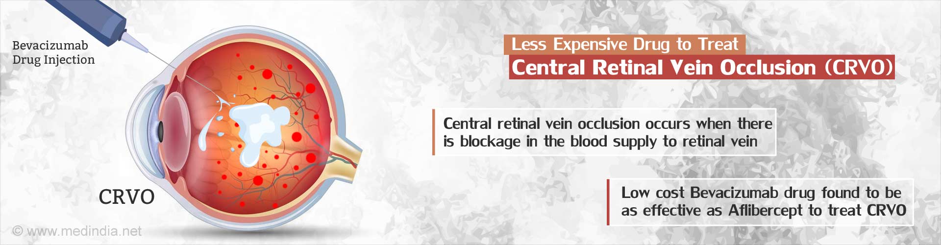 Less expensive drug to treat central retinal vein occlusion (CRVO)
- Central retinal vein occlusion occurs when there is blockage in the blood supply to retinal vein
- Low cost Bevacizumab drug found to be as effective as Aflibercept to treat CRVO