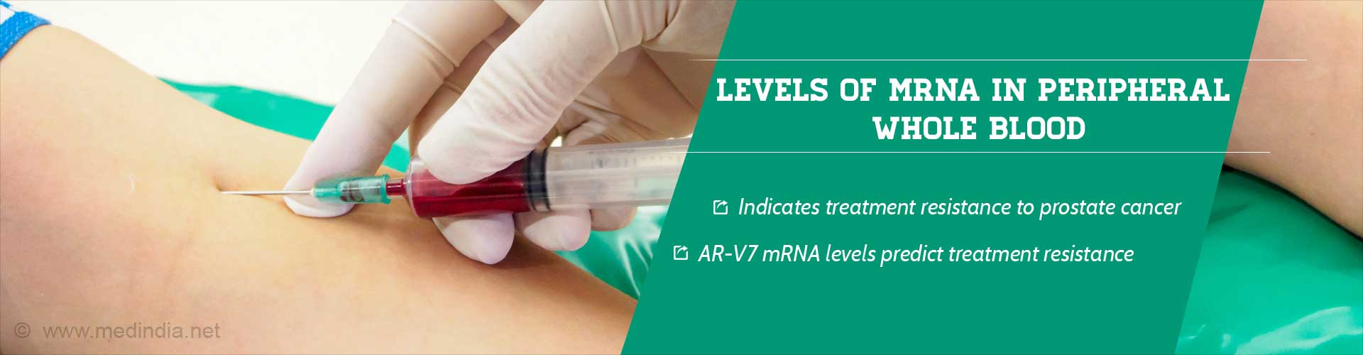 Levels of MRNA in peripheral whole blood
- Indicates treatment resistance to prostate cancer
- AR-V7 mRNA levels predict treatment resistance