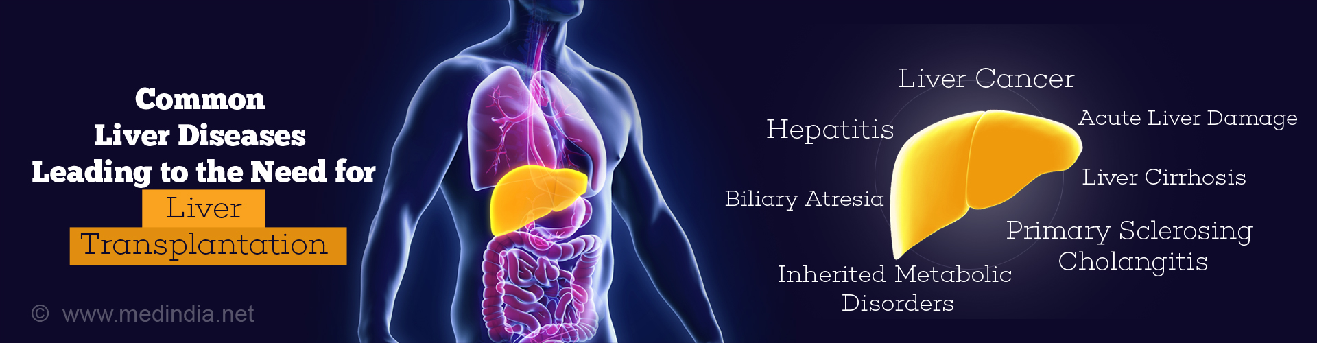 Common Types of Liver Diseases Leading To The Need for Liver Transplantation
- Liver cancer
- Hepatitis
- Biliary Atresia
- Inherited Metabolic Disorders
- Acute Liver Damage
- Liver Cirrhosis
- Primary Sclerosing Cholangitis