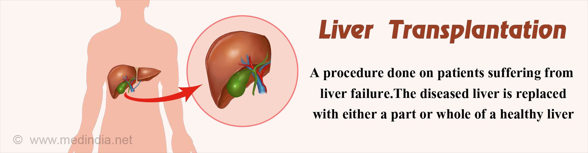 Liver Transplantation - A procedure done on patients suffering from liver failure. The diseased liver is replaced with either a part or whole of a healthy liver.