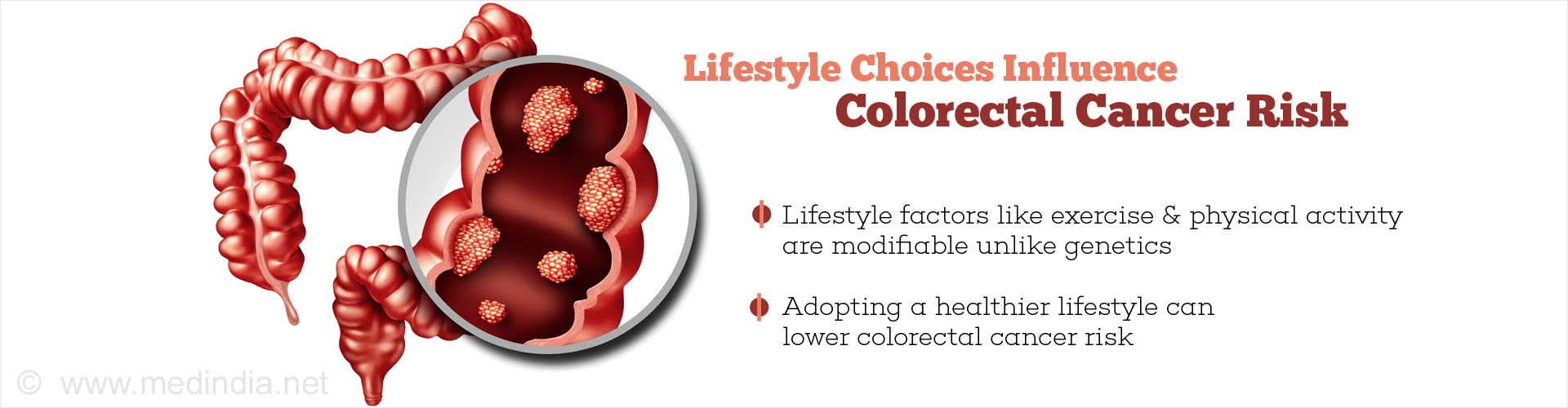 lifestyle choices influence colorectal cancer risk
- lifestyle factors like exercise and physical activity
- adopting a healthier lifestyle can lower colorectal cancer risk
