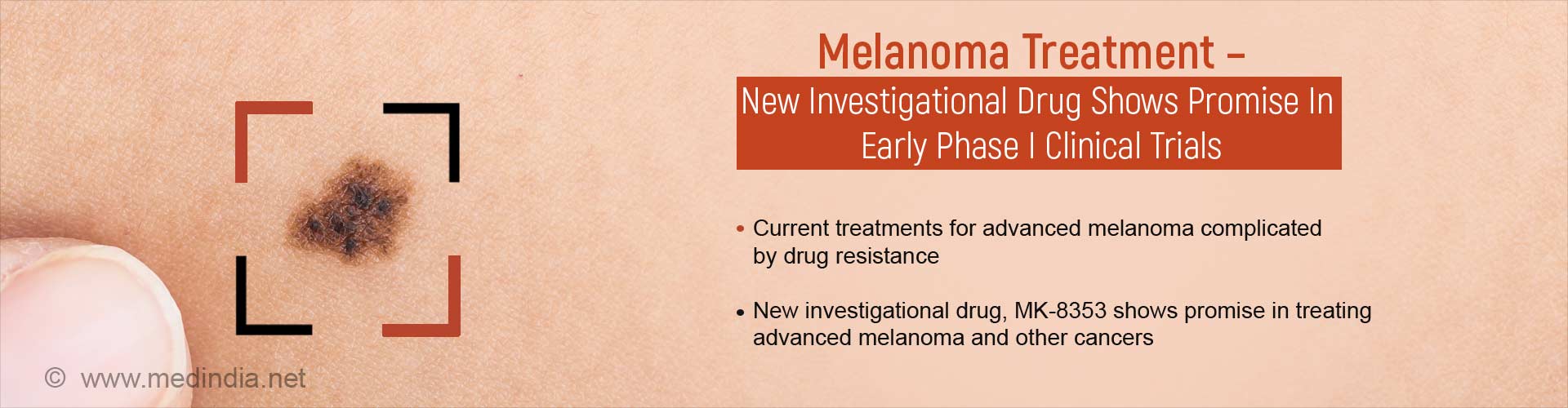 melanoma treatment - new inverstigational drug shows promise in early phase 1 clinical trials
- current treatments to advanced melanoma complicated by dug resistance
- new investigational drug, MK-8353 shows promise in treating advanced melanoma and other cancers