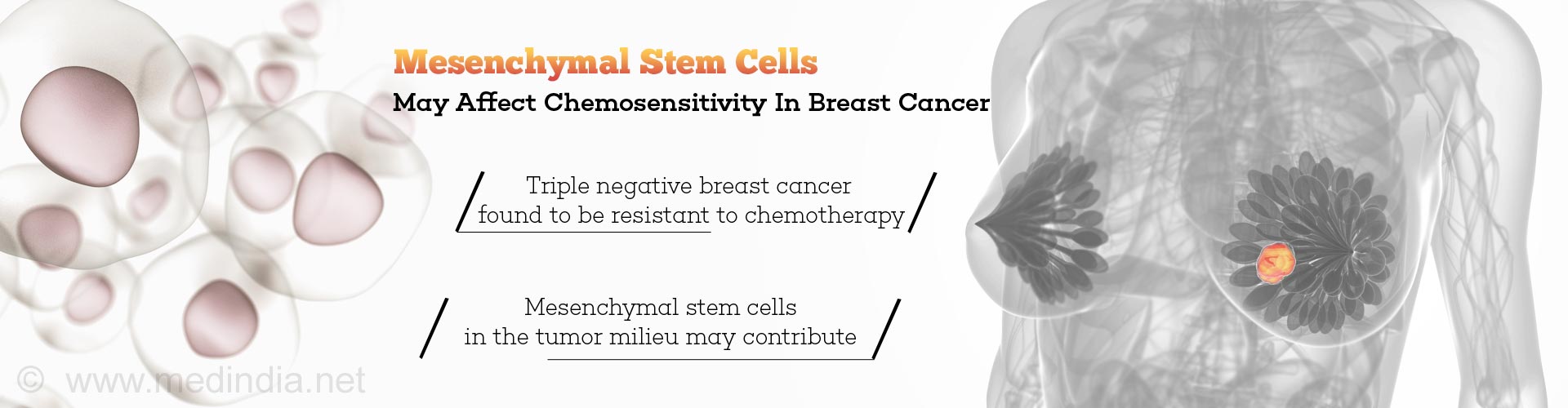 Mesenchymal Stem Cells May Affect Chemosensitivity in Breast Cancer
- Triple negative breast cancer found to be resistant to chemotherapy
- Mesenchymal stem cells in the tumor milieu may contribute
