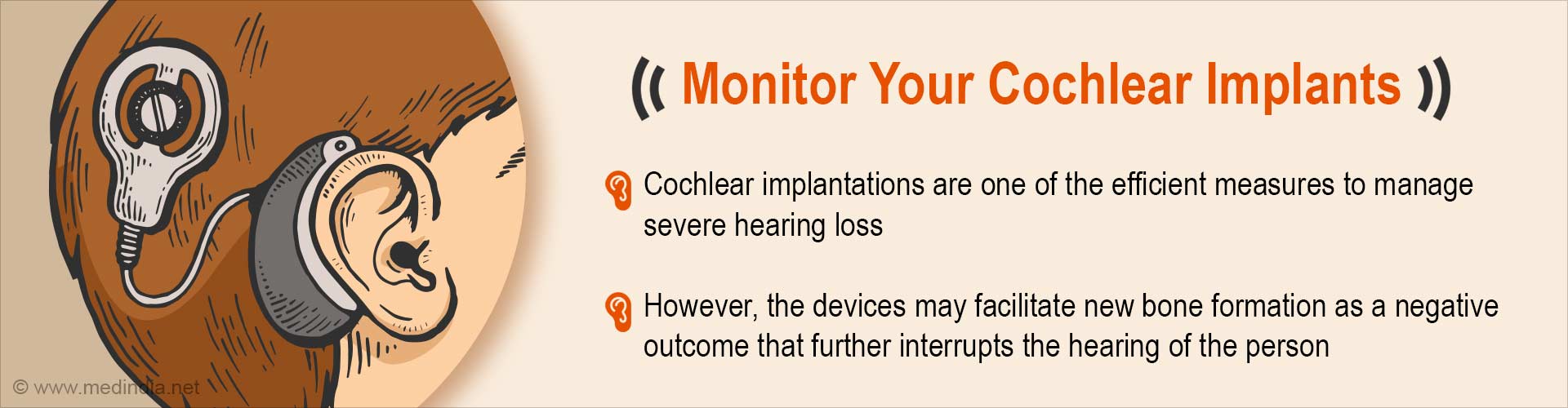 Cochlear Implants may Consequently Drive Hearing Loss
