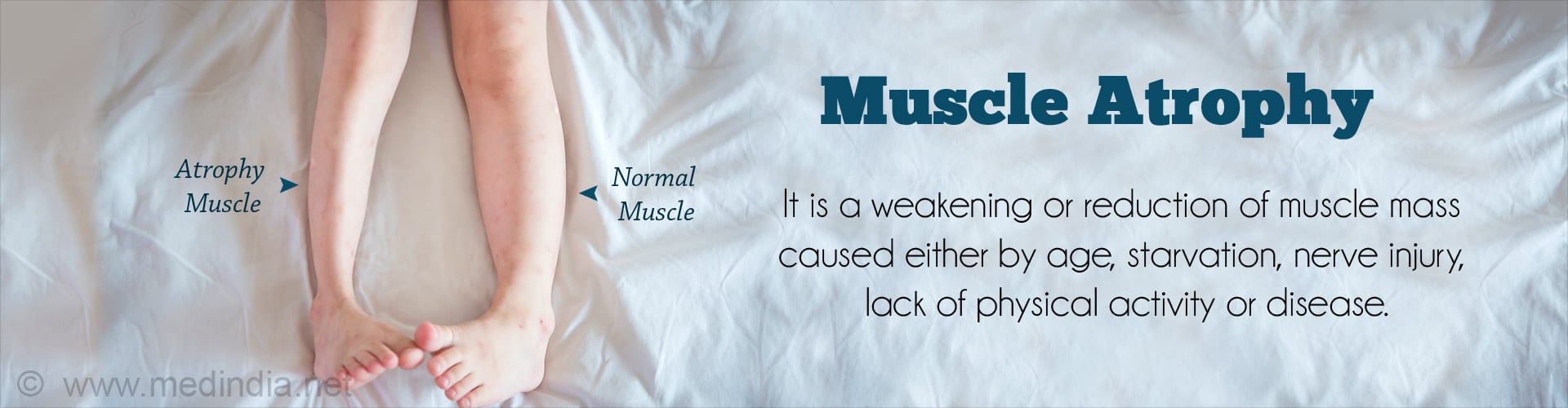 Muscle Atrophy: It is a weakening or reduction of muscle mass caused either by age, starvation, nerve injury, lack of physical activity or disease