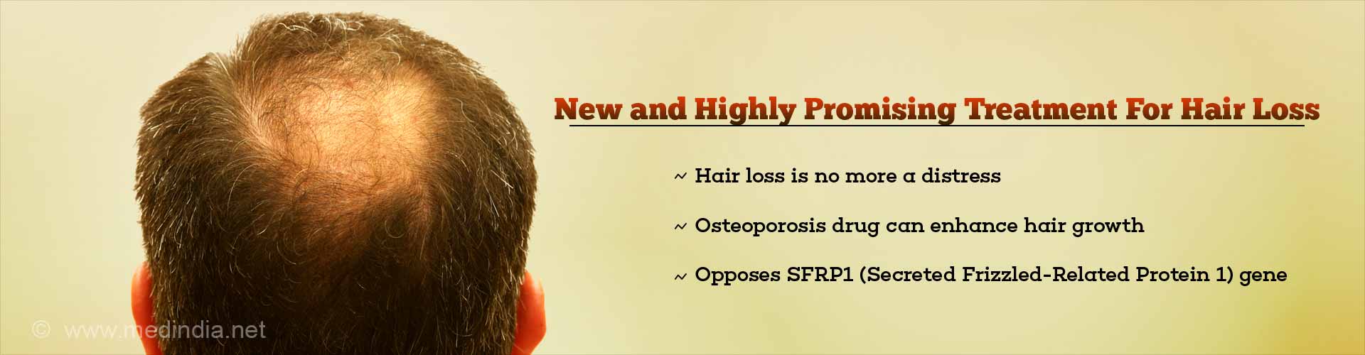 new and highly promising treatment for hair loss
- hair loss is no more a distress
- osteoporosis drug can enhance hair growth
- opposes SFRP1 (secreted frizzled-related protein 1) gene