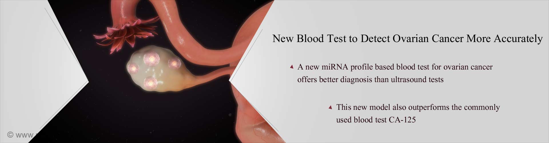 new blood test to detect ovarian cancer more accurately
- A new miRNA profile based blood test for ovarian cancer offers better diagnosis than ultrasound tests
- This new model also outperforms the commonly used blood test CA-125