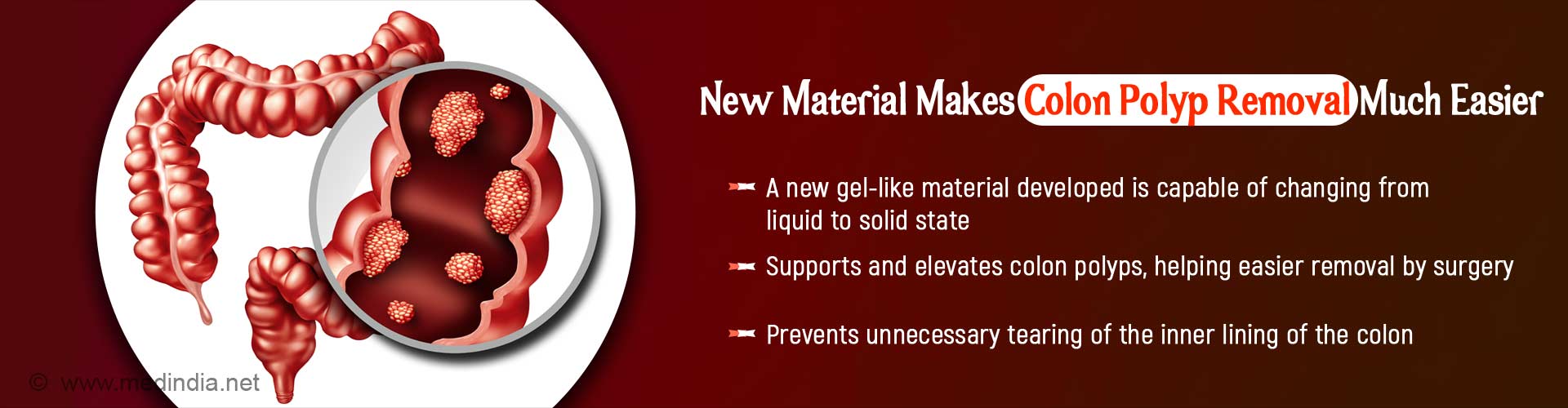 New material makes colon polyps removal much easier. A new gel-like material developed is capable of changing from liquid to solid state. Supports and elevates colon polyps, helping easier removal by surgery. Prevents unnecessary tearing of the inner lining of the colon.