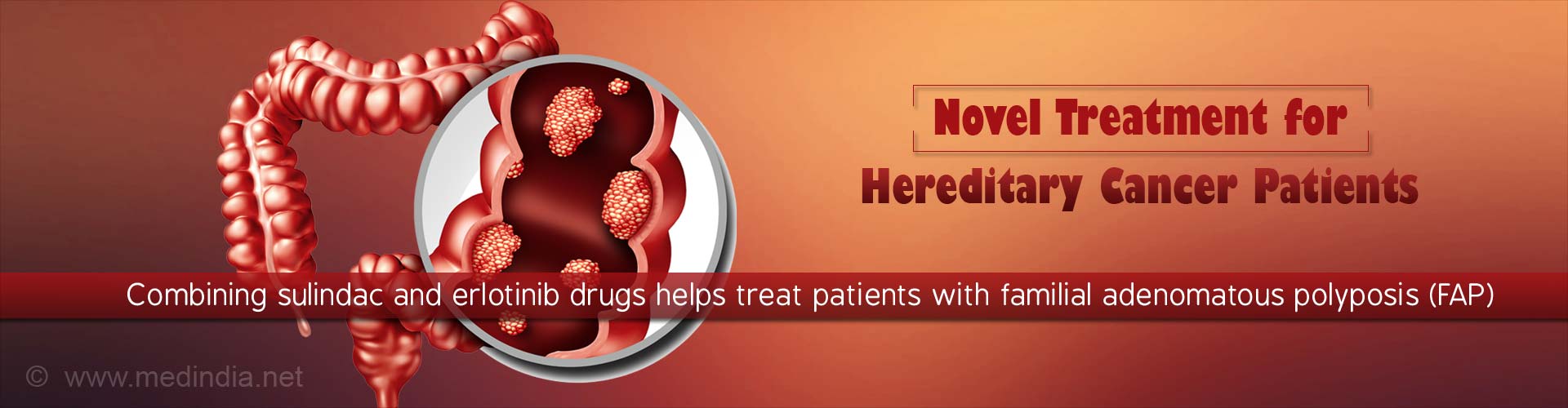 novel treatment for hereditary cancer patients
- combining sulindac and erlotinib drugs helps treat patients with familial adenomatous polyposis (FAP)