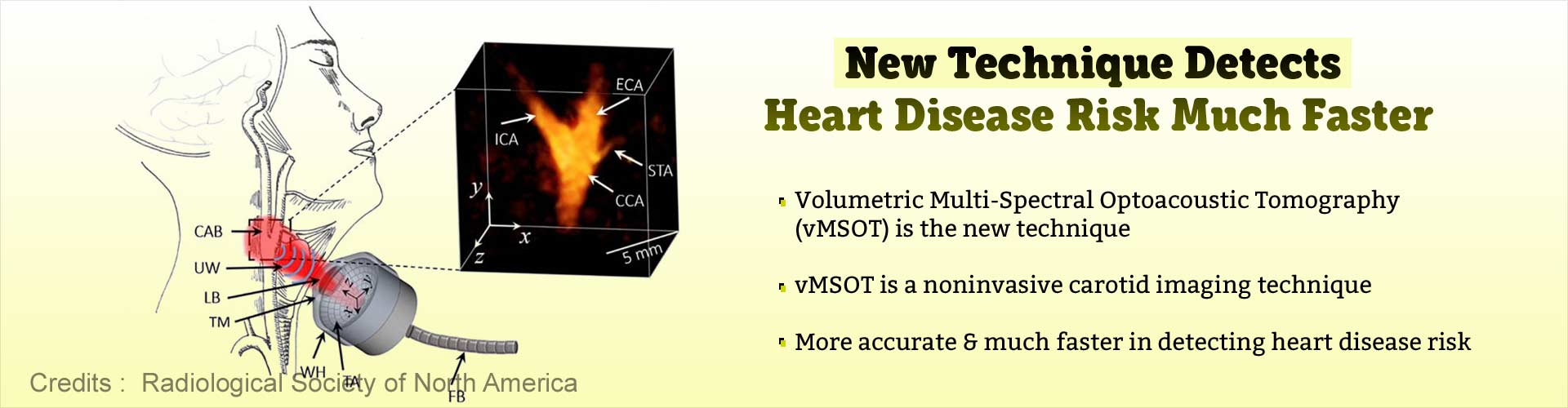 New technique detects heart disease risk much faster. Volumetric Multi-Spectral Optoacoustic Tomography (vMSOT) is the new technique. vMSOT is a noninvasive carotid imaging technique. More accurate and much faster in detecting heart disease risk.  
