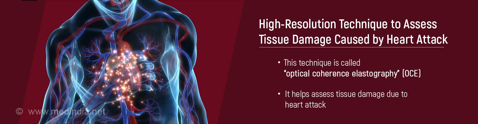 High-resolution technique to assess tissue damage caused by heart attack
- this technique is called ''optical coherence elastography'' (OCE)
- it helps assess tissue damage due to heart attack