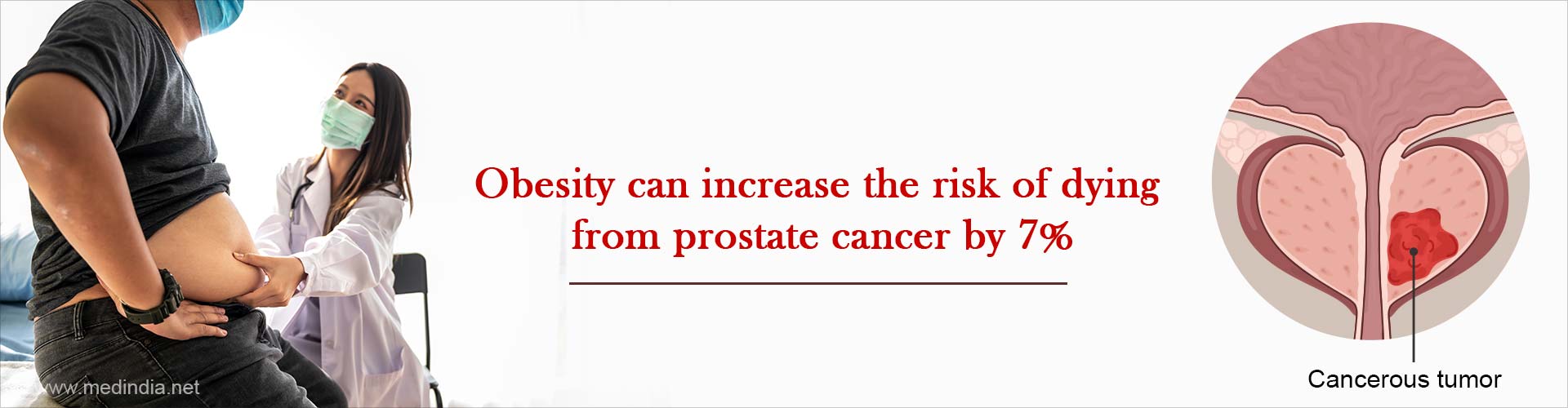 Obesity Linked to Higher Risk of Fatal Prostate Cancer
