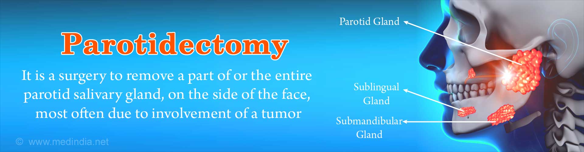 Parotidectomy is a surgery to remove a part of or the entire parotid salivary gland, on the side of the face, most often due to involvement by a tumor.