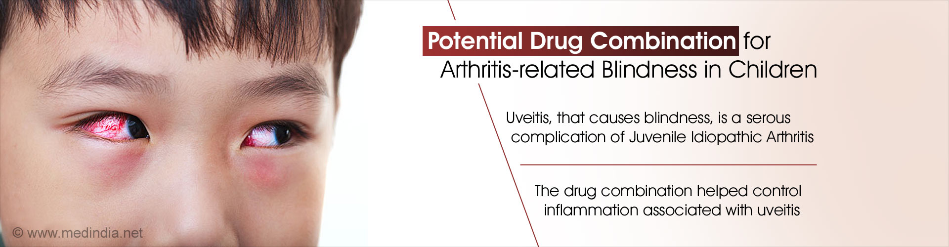 潜在的药物组合arthritis-related失明的孩子——葡萄膜炎,导致青少年特发性关节炎的失明是一种严重的并发症——药物组合有助于控制炎症与葡萄膜炎有关