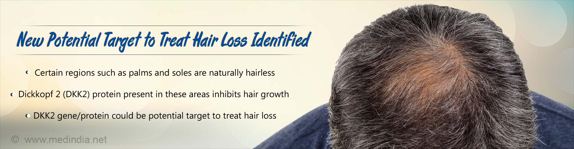 New potential target to treat hair loss identified. Certain regions such as palms and soles are naturally hairless. Dickkopf 2 (DKK2) protein present in these areas inhibits hair growth. DKK2 gene/protein could be potential target to treat hair loss.